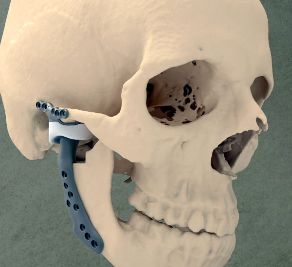 Cette prothèse articulaire en titane imprimée en 3D est une première !